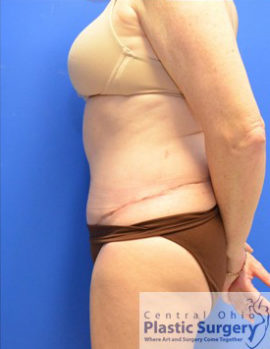 Tummy Tuck