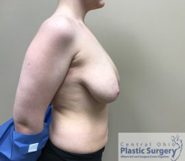 Breast Reduction