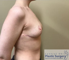 Breast Reduction