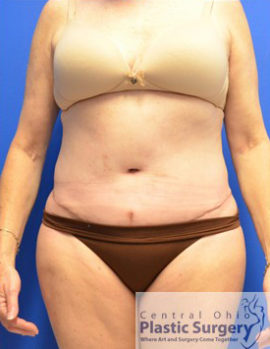 Tummy Tuck