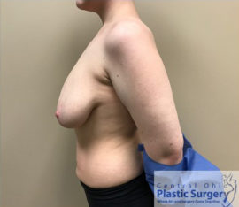Breast Reduction/Breast Lift