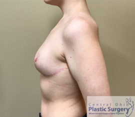 Breast Reduction/Breast Lift