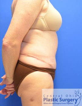 Tummy Tuck