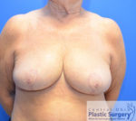 Breast Reduction/Breast Lift