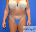 Tummy Tuck