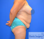 Tummy Tuck