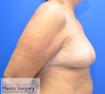 Breast Reduction