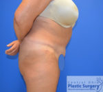 Tummy Tuck