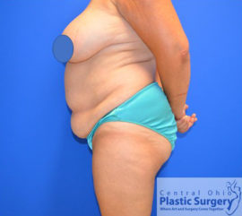 Tummy Tuck