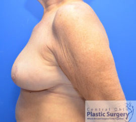 Breast Reduction/Breast Lift
