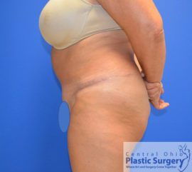 Tummy Tuck