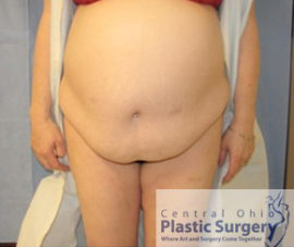 Tummy Tuck