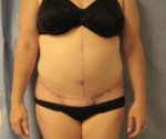 Tummy Tuck