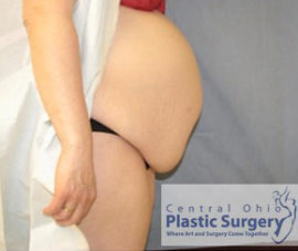 Tummy Tuck