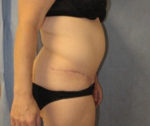 Tummy Tuck