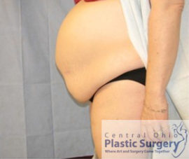 Tummy Tuck