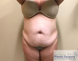 Tummy Tuck