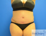 Tummy Tuck