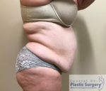 Tummy Tuck