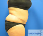 Tummy Tuck