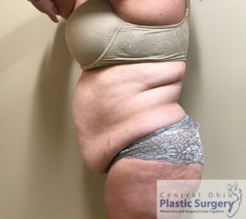 Tummy Tuck