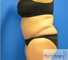 Tummy Tuck