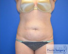 Tummy Tuck