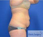 Tummy Tuck