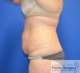 Tummy Tuck