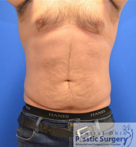 Liposuction