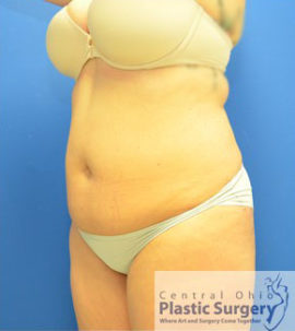 Liposuction