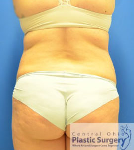 Liposuction