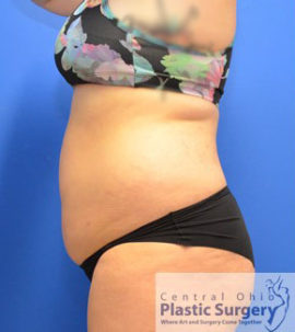 Liposuction Case 15016 Before Photo Liposuction