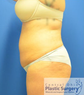 Liposuction