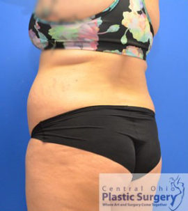 Liposuction