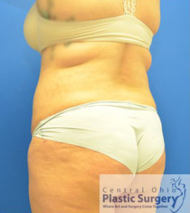 Liposuction