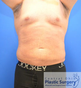 Liposuction