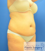 Liposuction