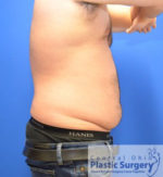 Liposuction