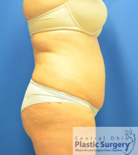 Liposuction