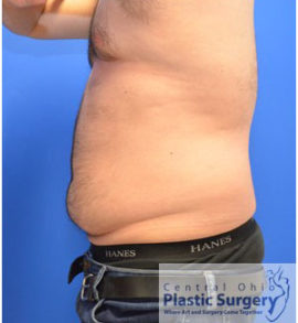 Liposuction