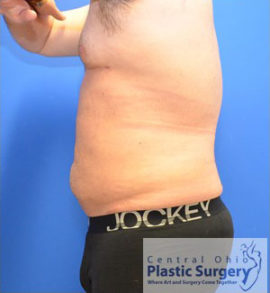 Liposuction