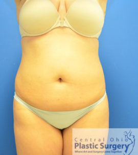 Liposuction