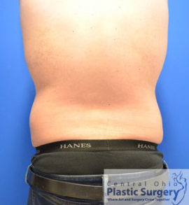 Liposuction Case 15033 Before Photo Liposuction