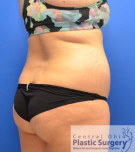 Liposuction