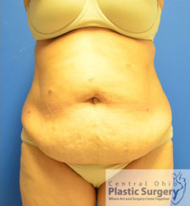 Tummy Tuck