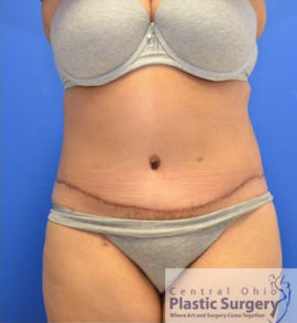 Tummy Tuck