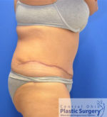 Tummy Tuck