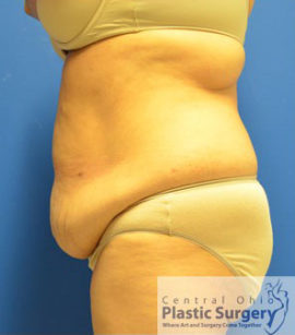 Tummy Tuck