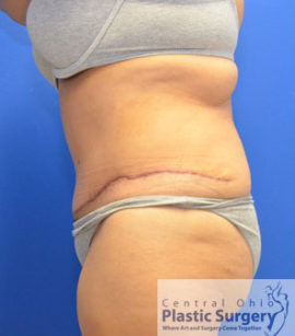 Tummy Tuck